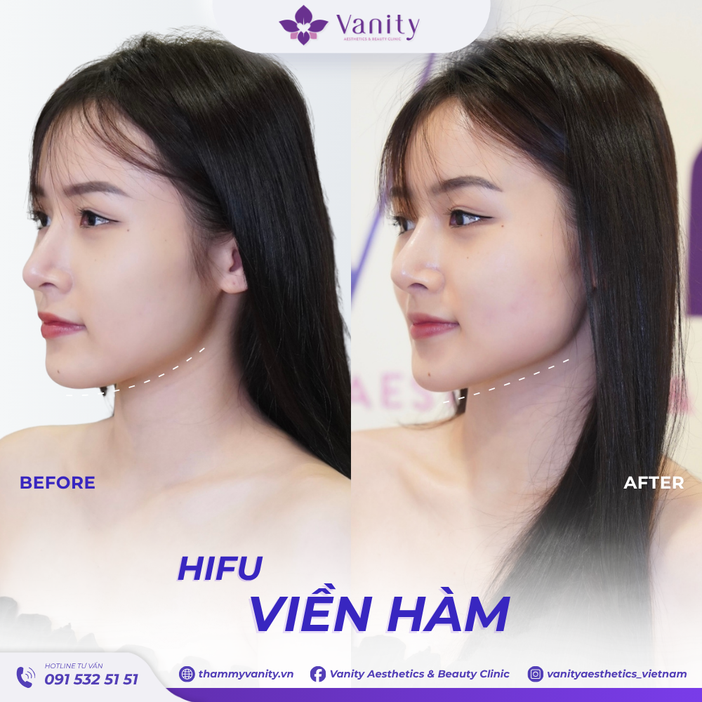 HIFU VIỀN HÀM
